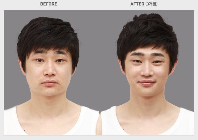 瘦脸果男的可以吃吗一般要吃多久