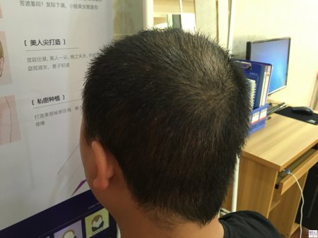 上海植发需要多少钱？怎么收费？
