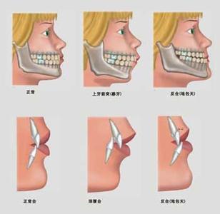 虎牙_什么是虎牙_虎牙矫正方法_虎牙矫正价格_美尚网
