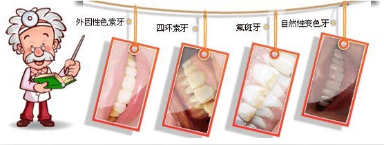 牙齿美白,美白牙齿