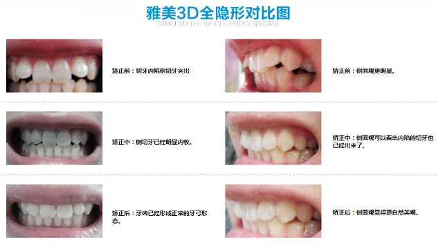 无痕牙齿矫正,3D全隐形牙齿矫正,牙齿矫正