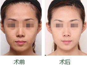 美白针